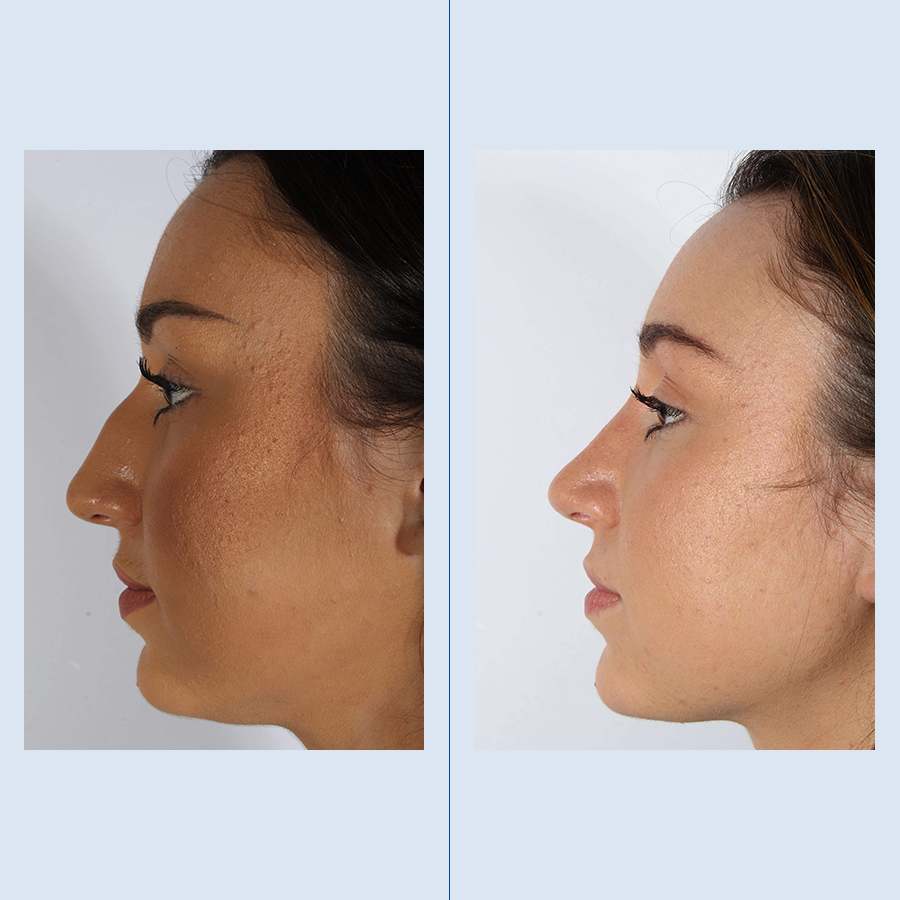 Antes y Después Ultrasonic Rhinoplasty