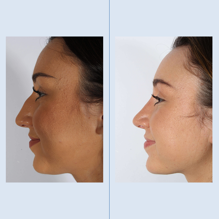 Antes y Después Ultrasonic Rhinoplasty