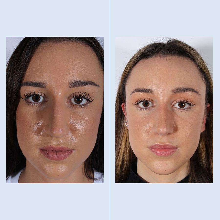 Antes y Después Rinoplastia Ultrasònica