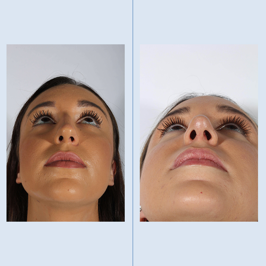 Antes y Después Ultrasonic Rhinoplasty