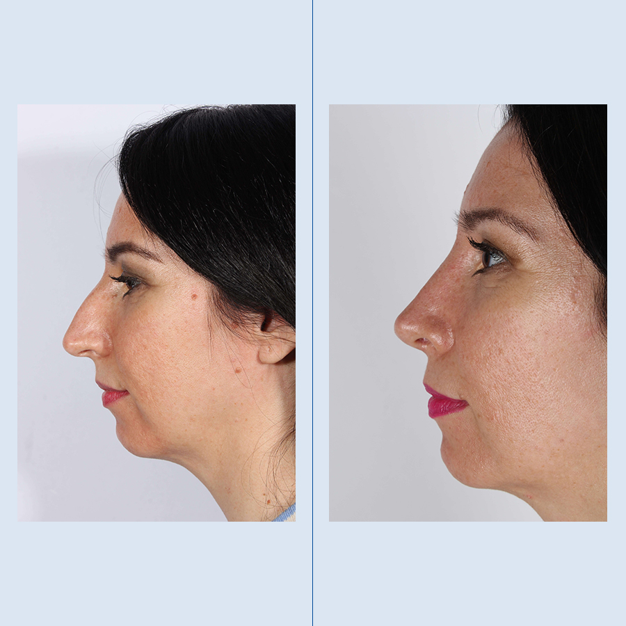 Antes y Después Rhinoplasty