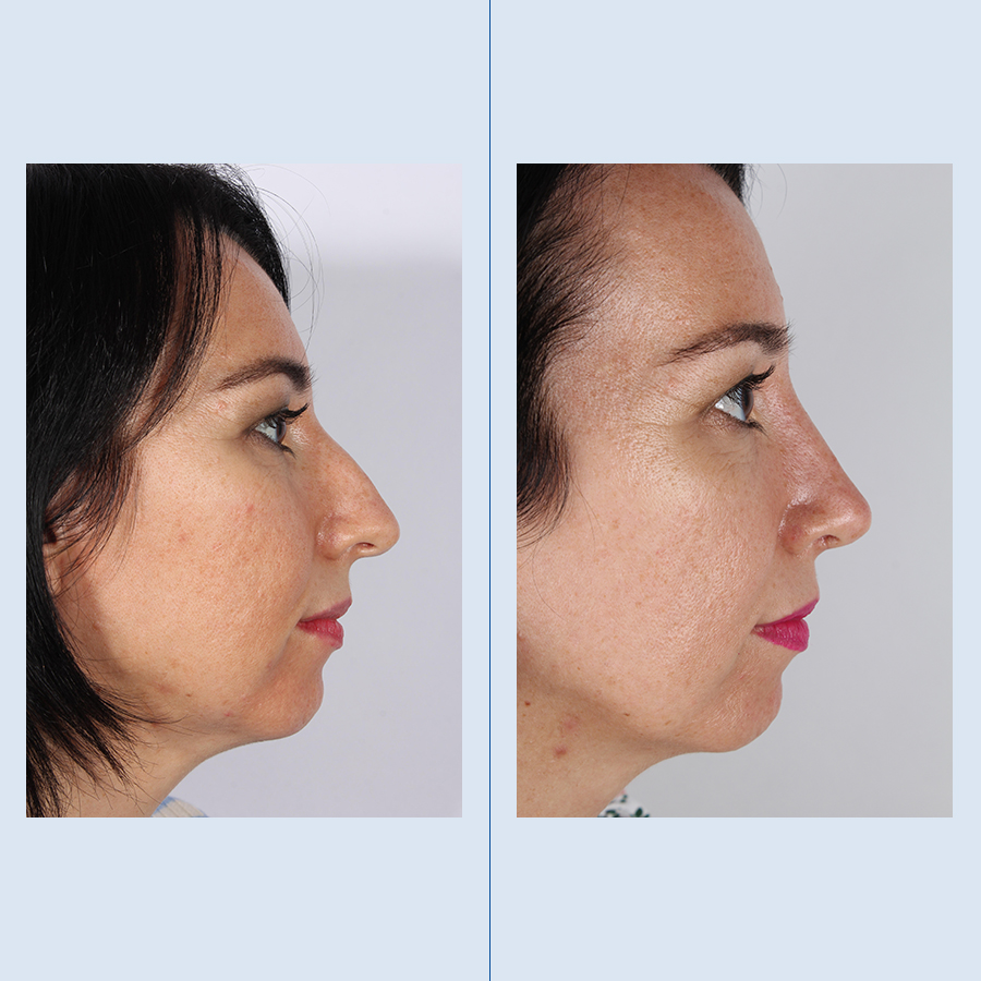 Rinoplastia Ultrasónica