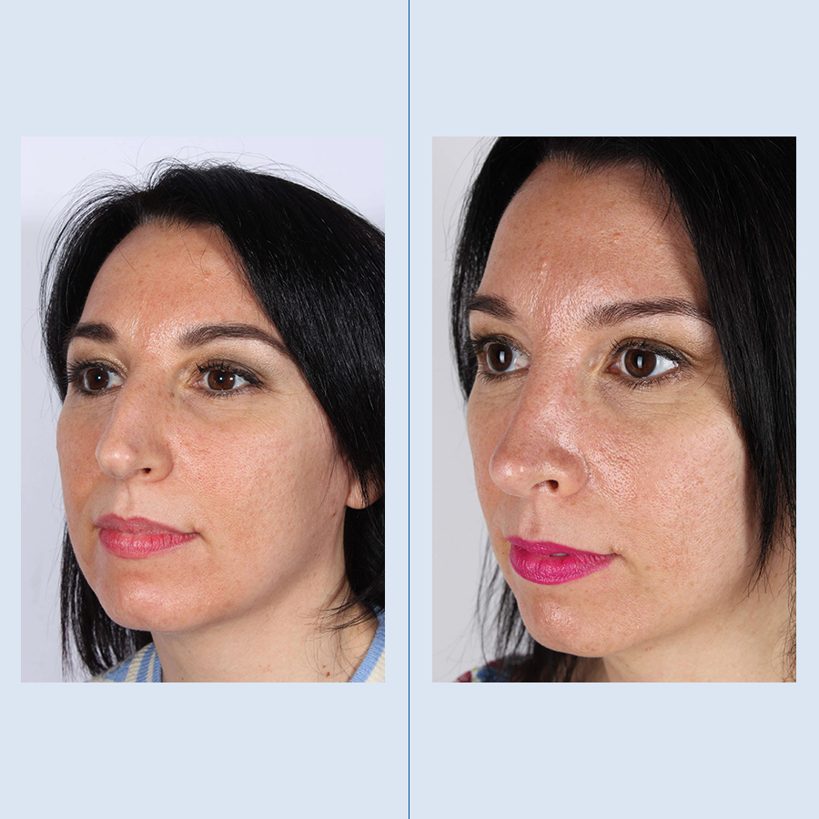 Antes y Después Rhinoplasty