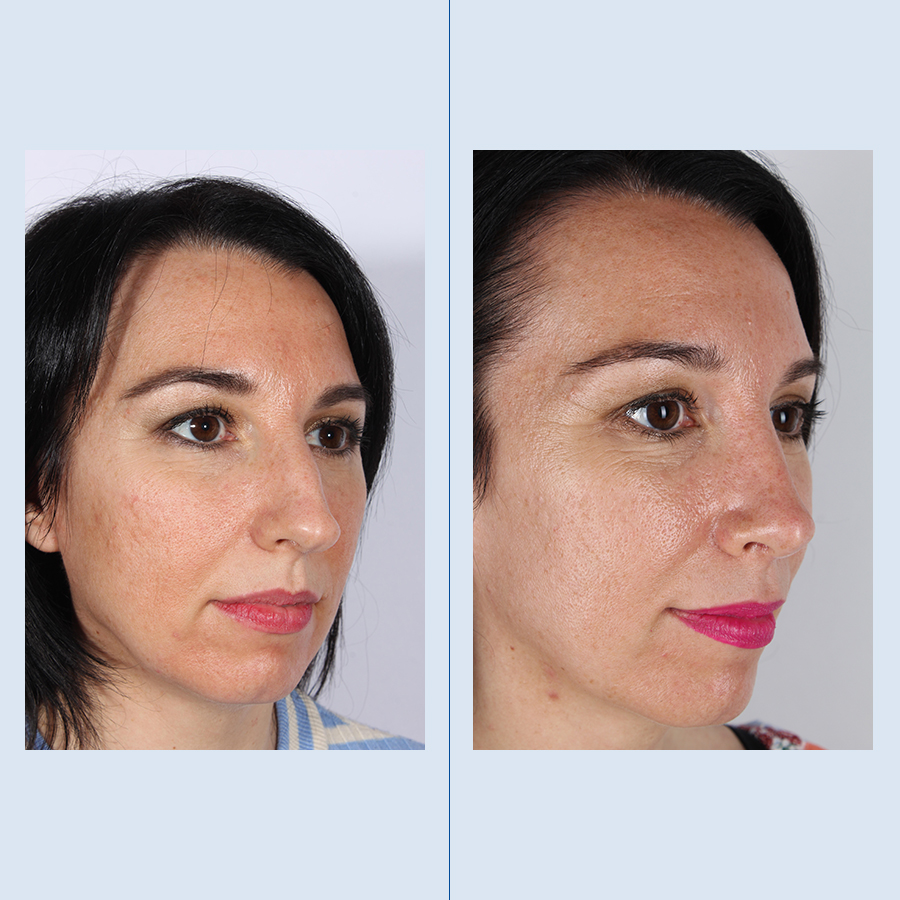 Rinoplastia Ultrasónica