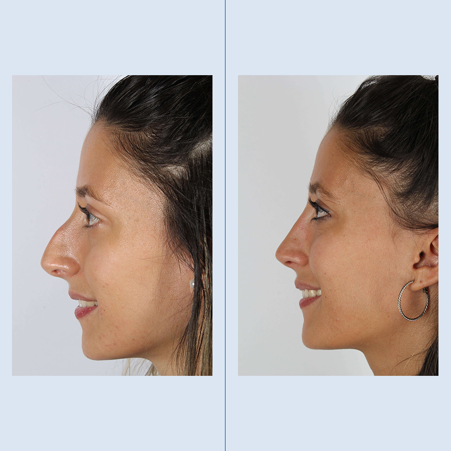 Antes y Después Rhinoplasty