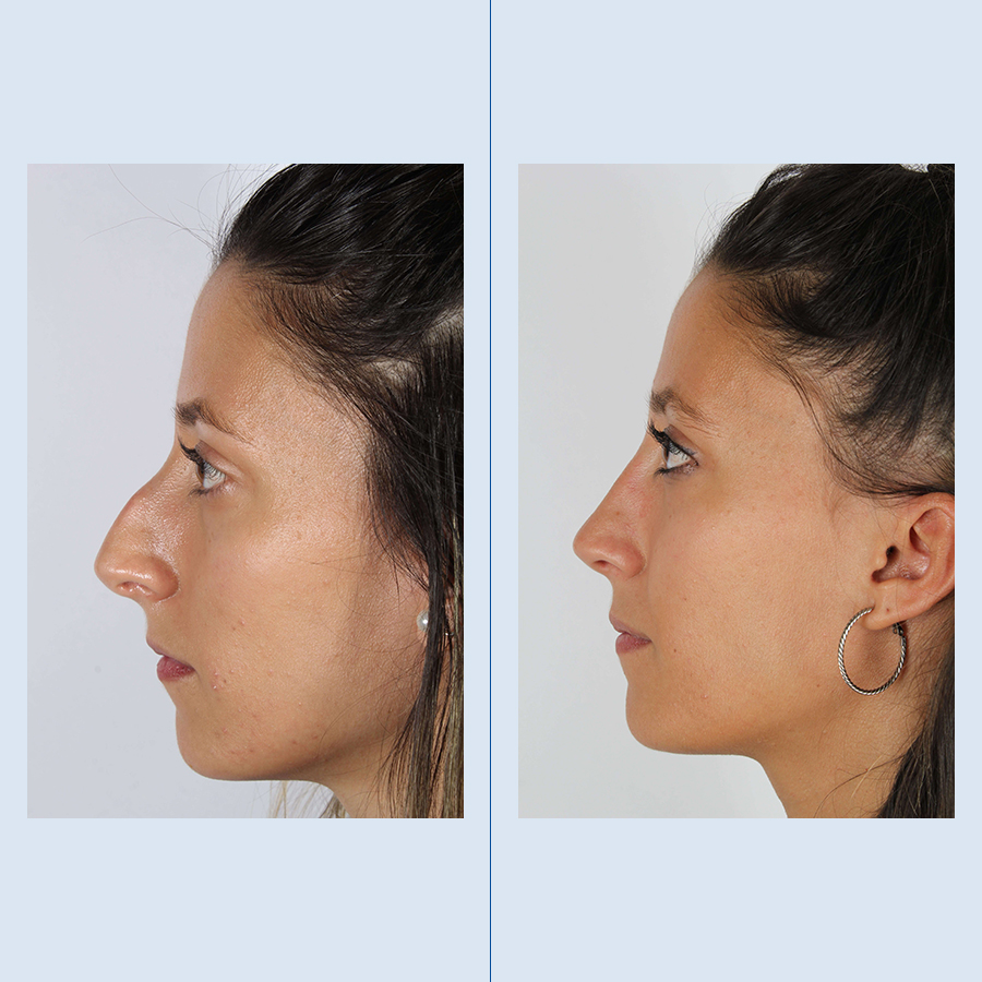 Antes y Después Rhinoplasty