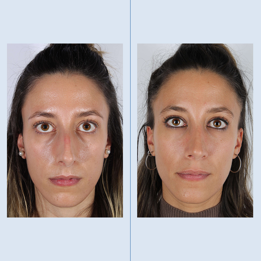 Antes y Después Rhinoplasty