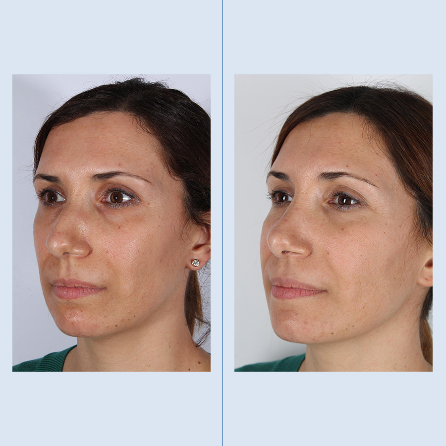 Rinoplastia Ultrasónica