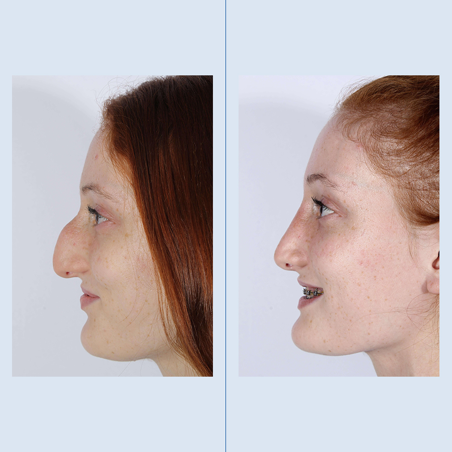 Antes y Después Ultrasonic Rhinoplasty