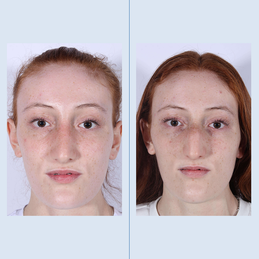 Antes y Después Ultrasonic Rhinoplasty