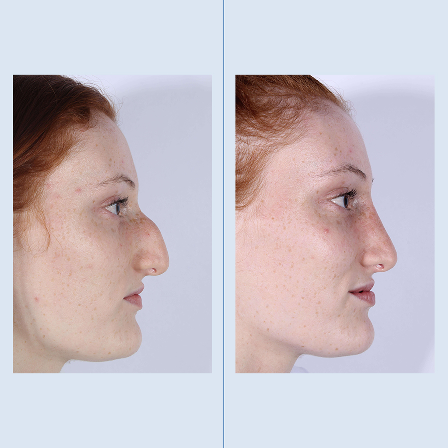 Antes y Después Rhinoplasty