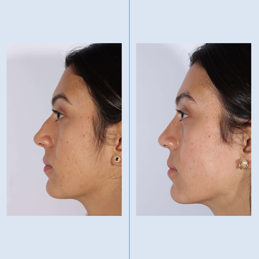 Antes y Después Rinoplastia Ultrasònica