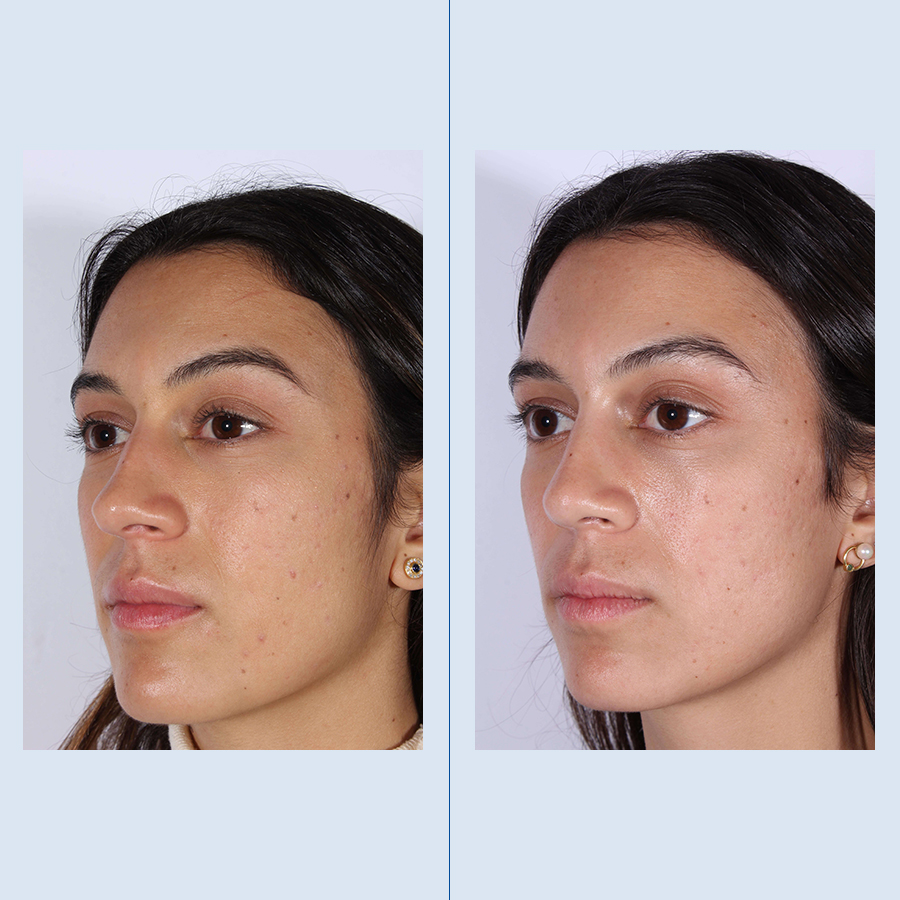 Antes y Después Ultrasonic Rhinoplasty