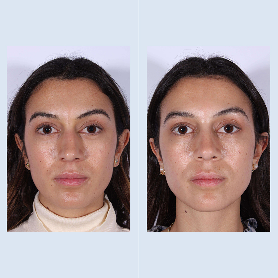 Antes y Después Rinoplastia Ultrasònica