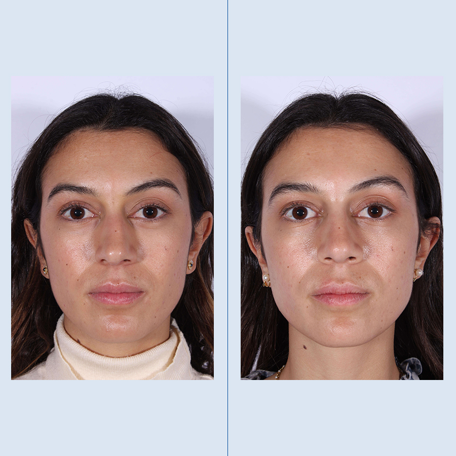 Antes y Después Cirurgía del nas