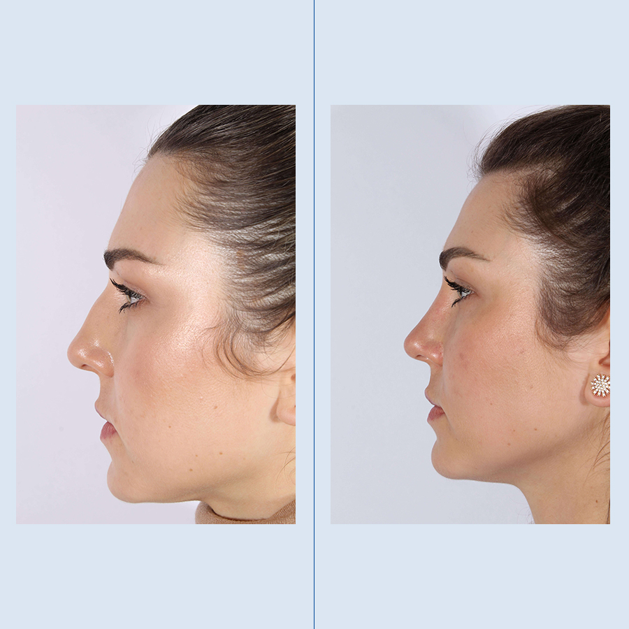 Antes y Después Ultrasonic Rhinoplasty