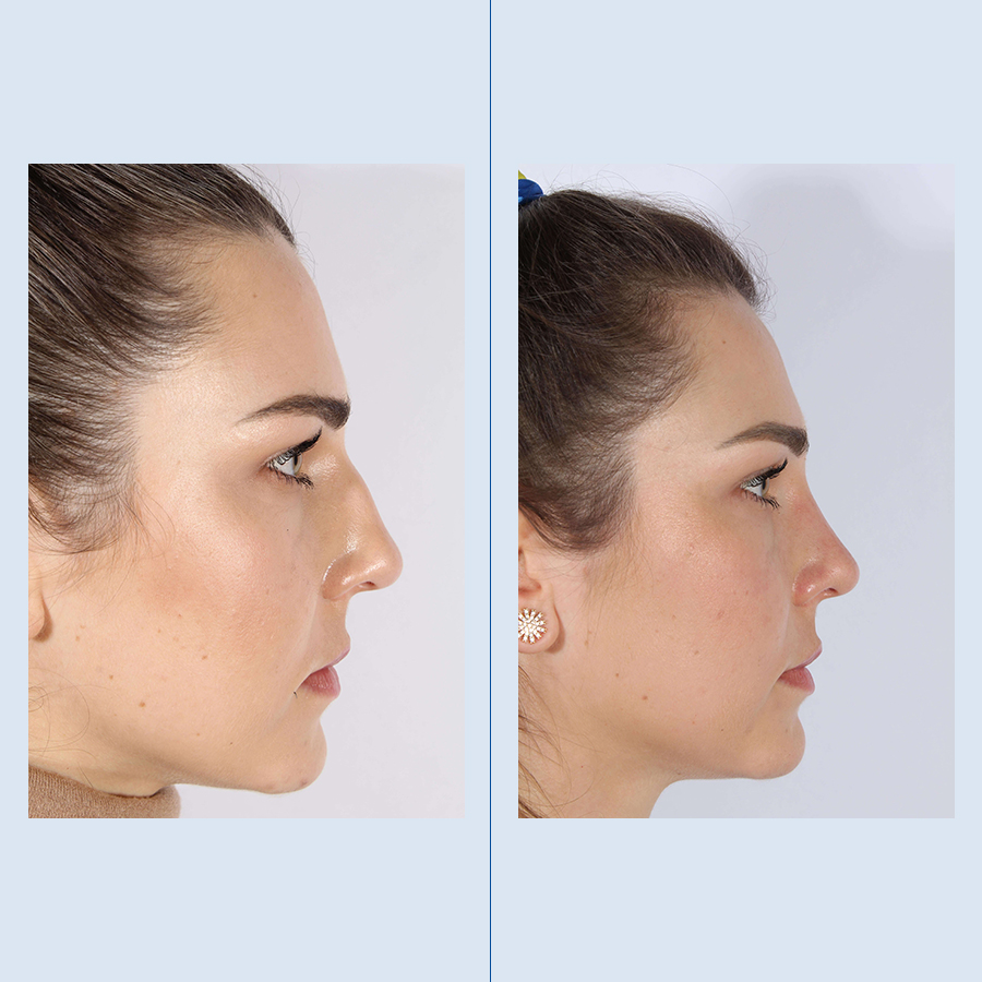 Antes y Después Ultrasonic Rhinoplasty