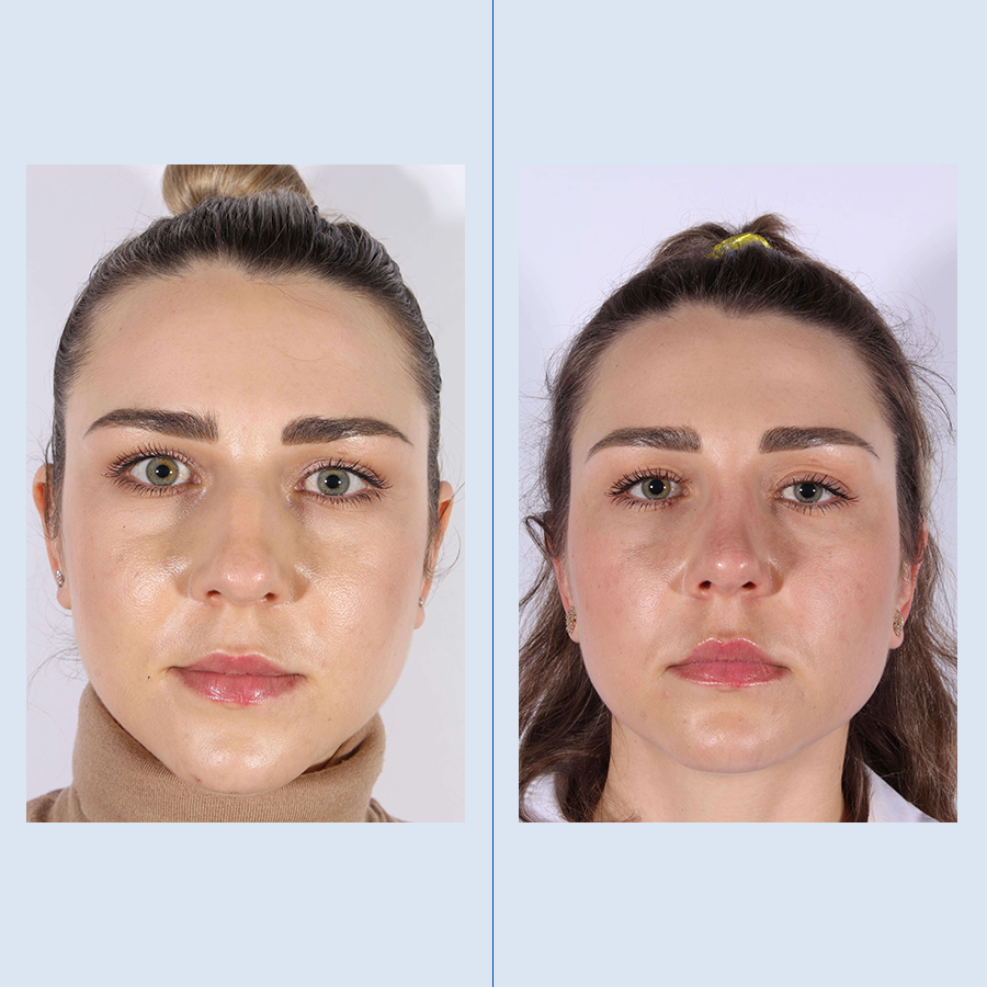 Antes y Después Rinoplastia Ultrasònica