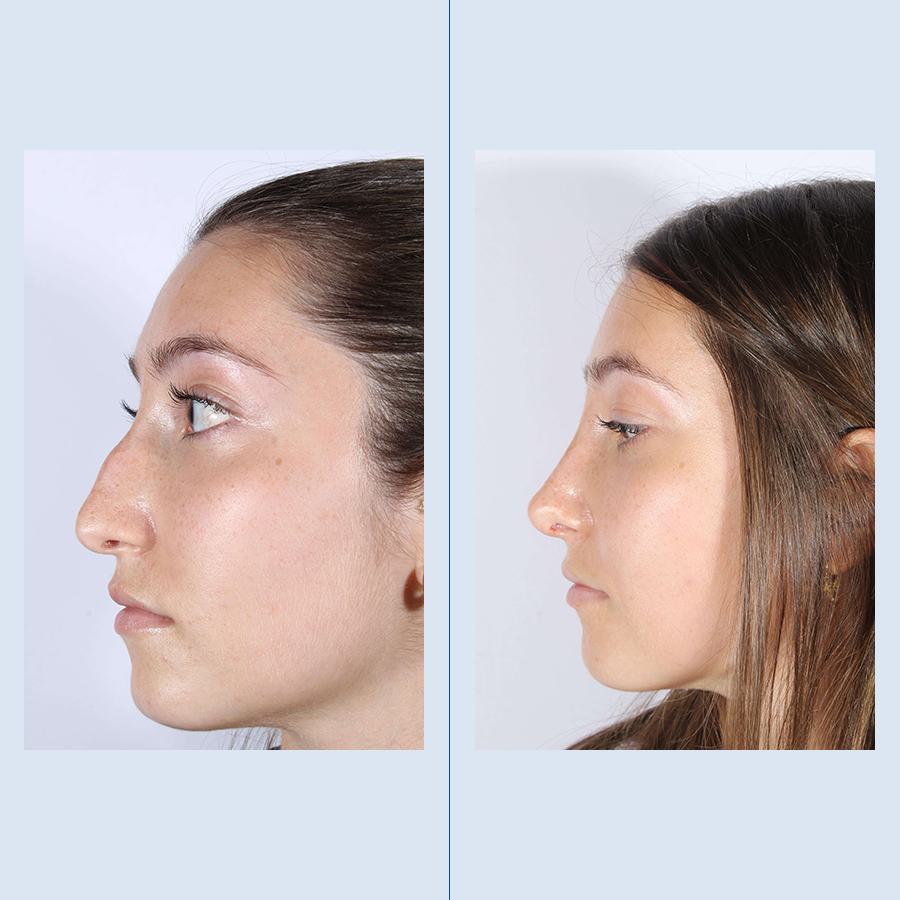 Antes y Después Ultrasonic Rhinoplasty