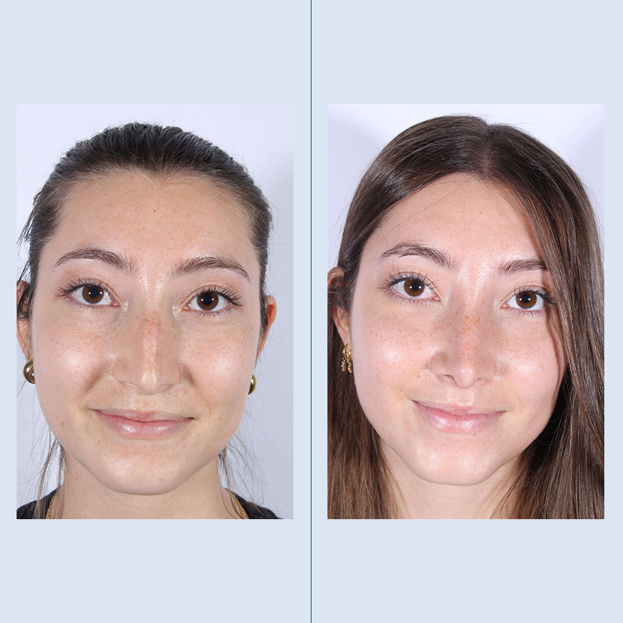 Antes y Después Ultrasonic Rhinoplasty