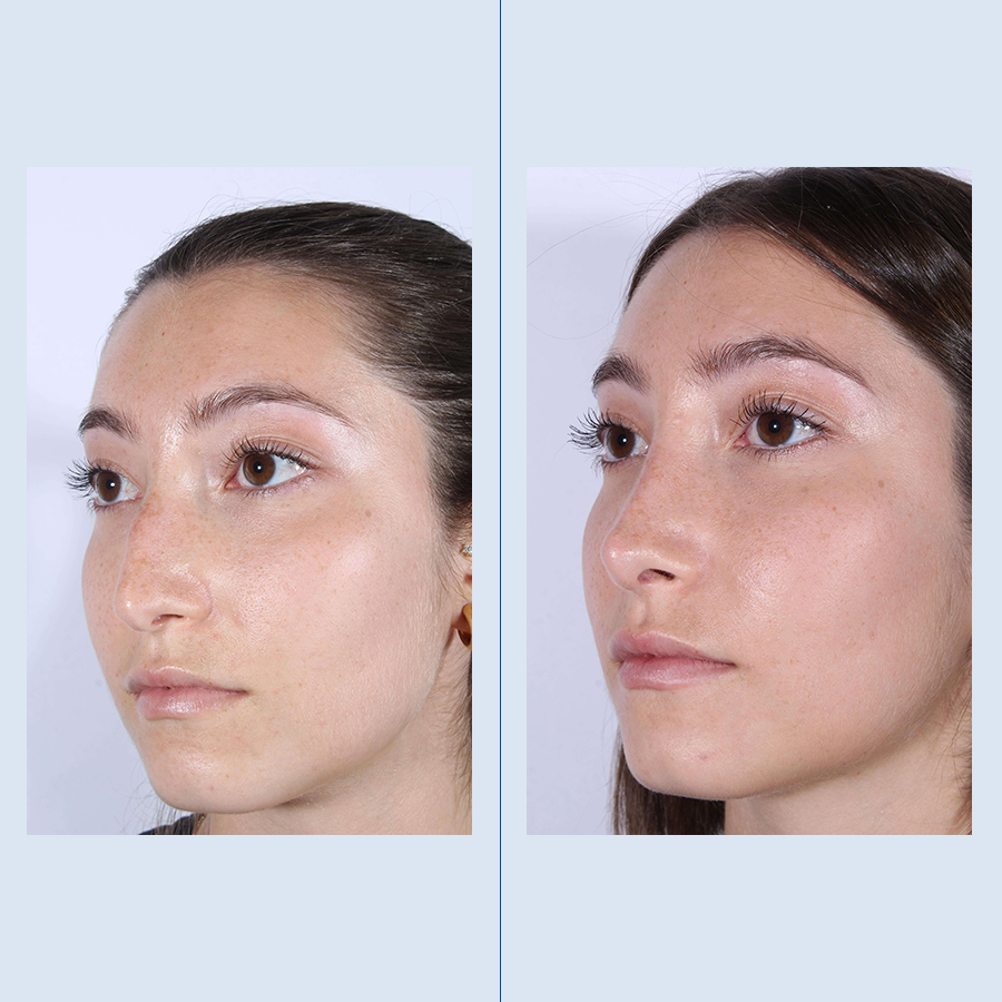 Antes y Después Rinoplastia Ultrasònica