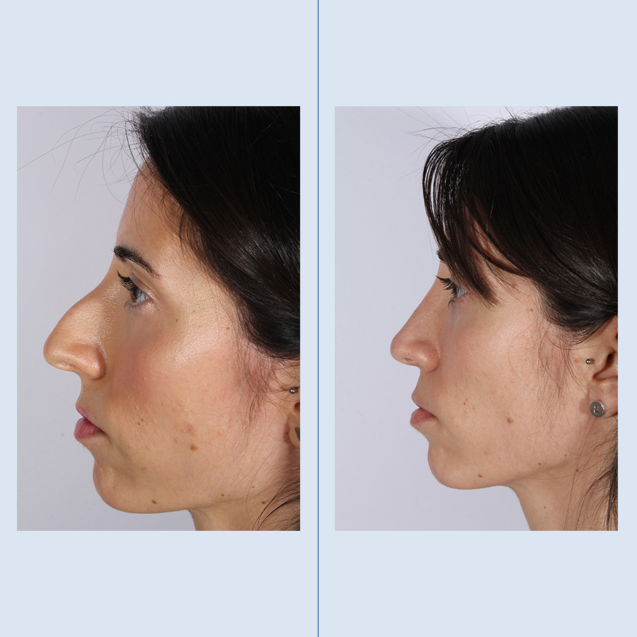 Antes y Después Rinoplastia Ultrasònica