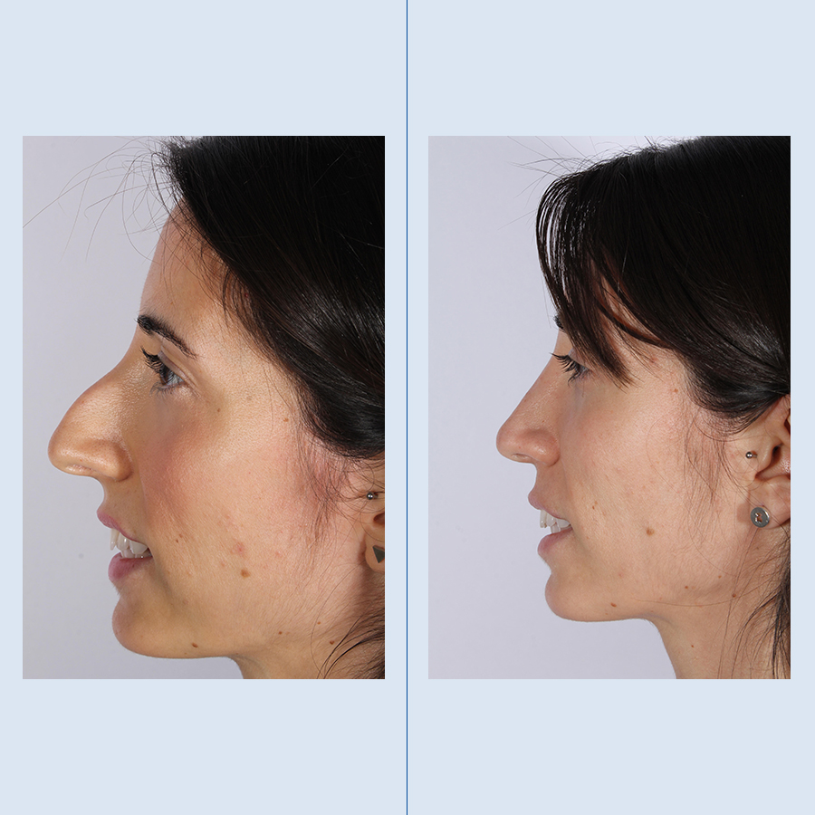 Antes y Después Ultrasonic Rhinoplasty