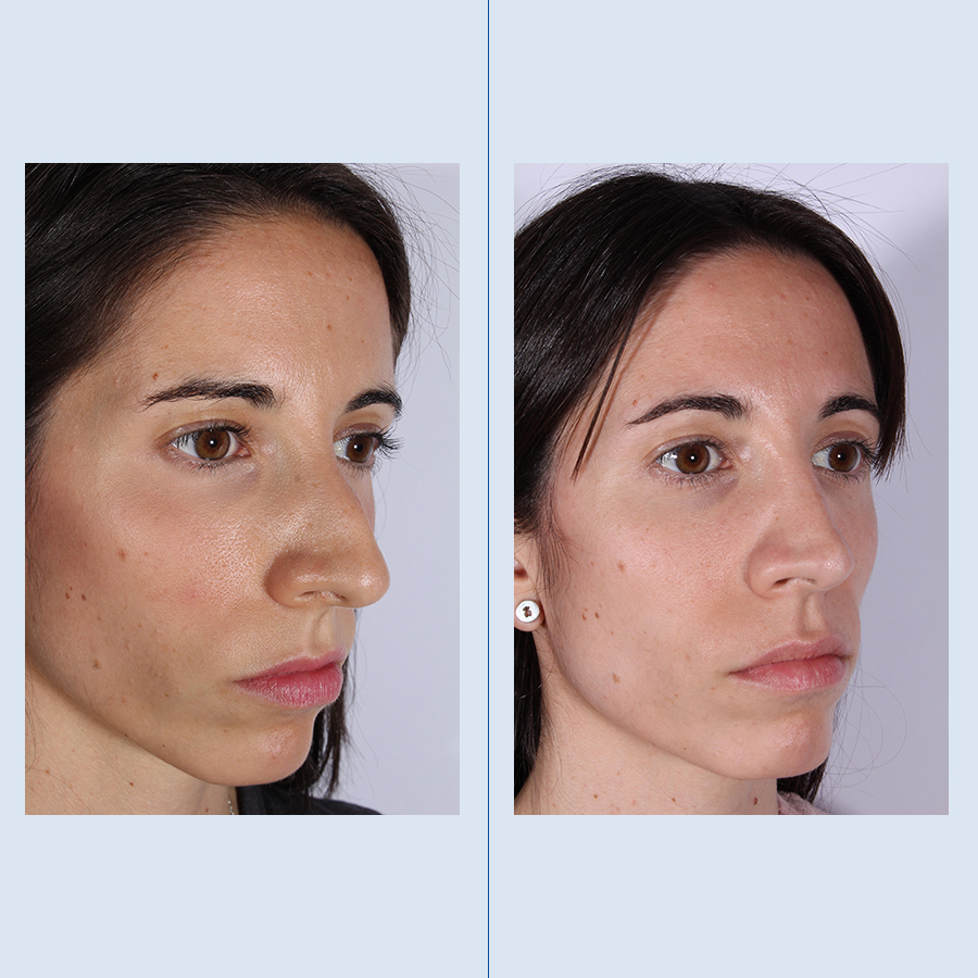 Antes y Después Rinoplastia Ultrasònica