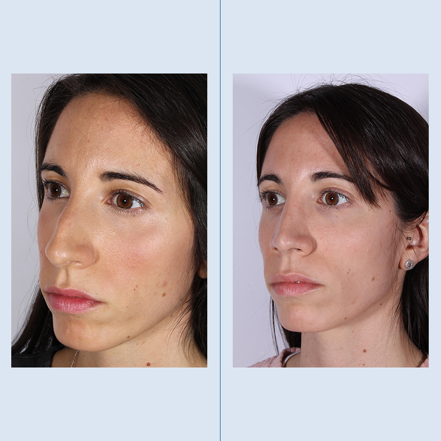 Antes y Después Ultrasonic Rhinoplasty