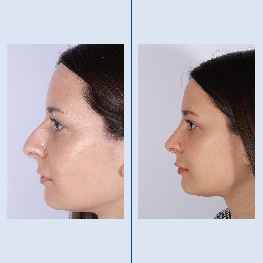 Antes y Después Ultrasonic Rhinoplasty