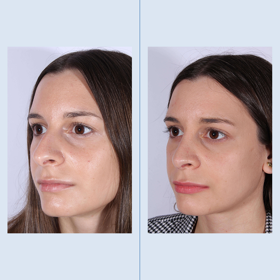 Antes y Después Ultrasonic Rhinoplasty