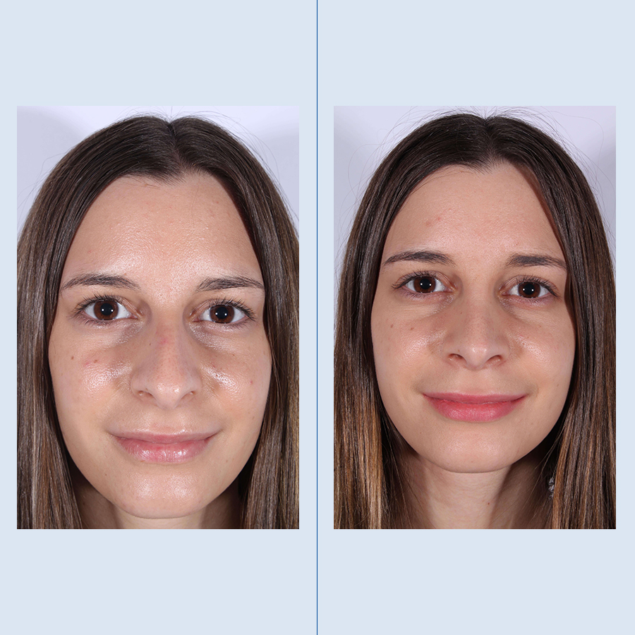 Antes y Después Rhinoplasty