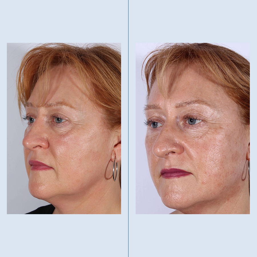 Rinoplastia Ultrasónica