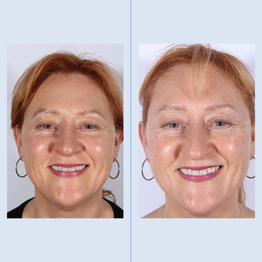 Rinoplastia Ultrasónica