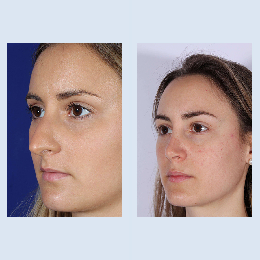 Rinoplastia Ultrasónica