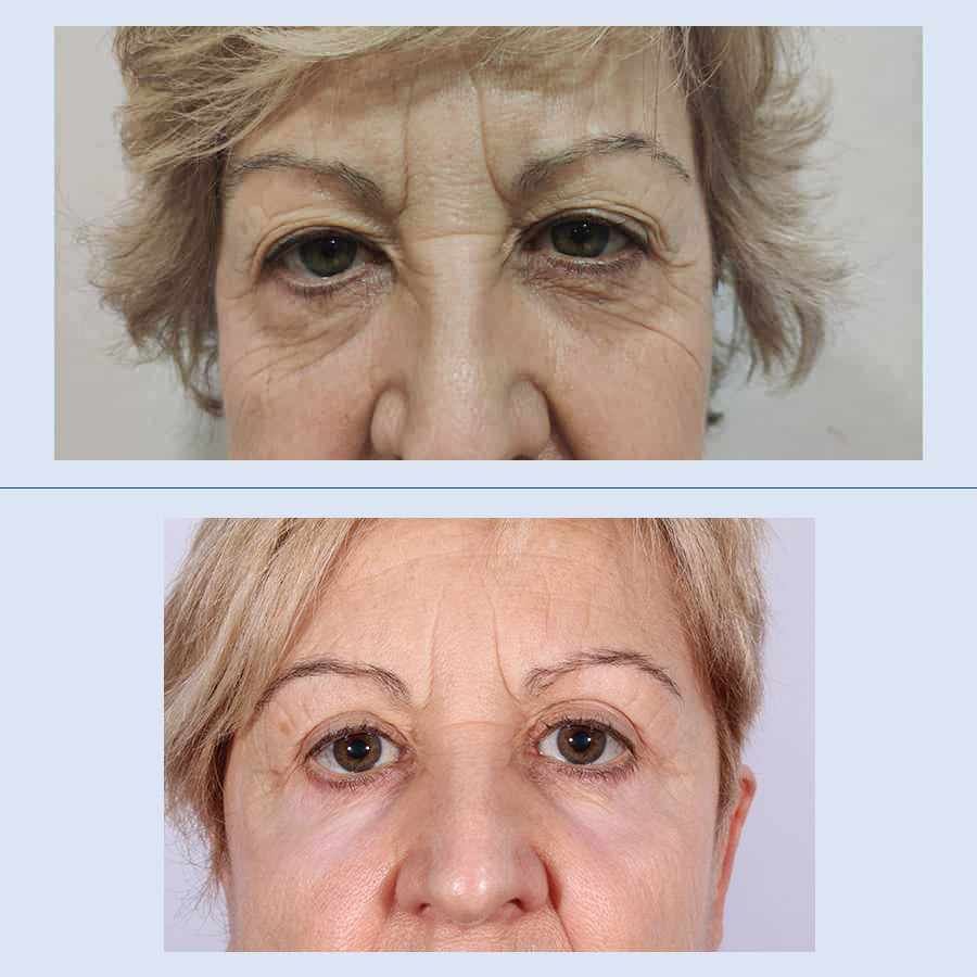 Antes y Después Blefaroplastia