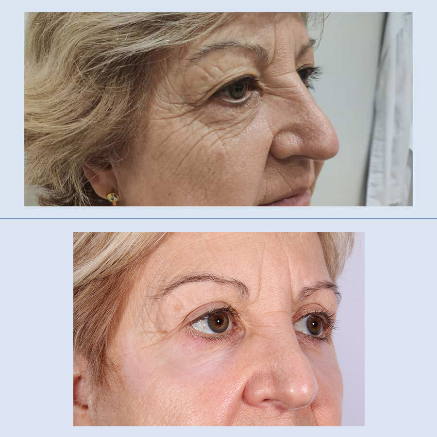 Antes y Después Blepharoplasty