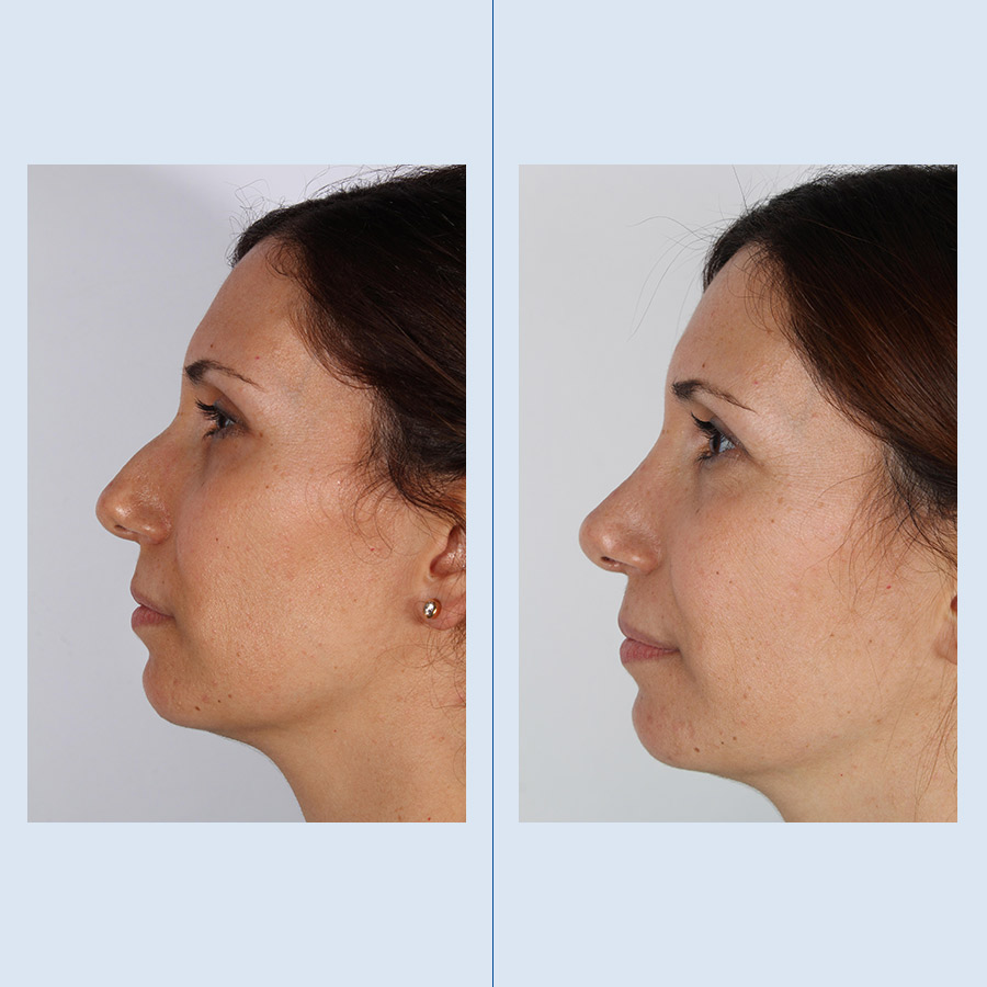 Rinoplastia Ultrasónica