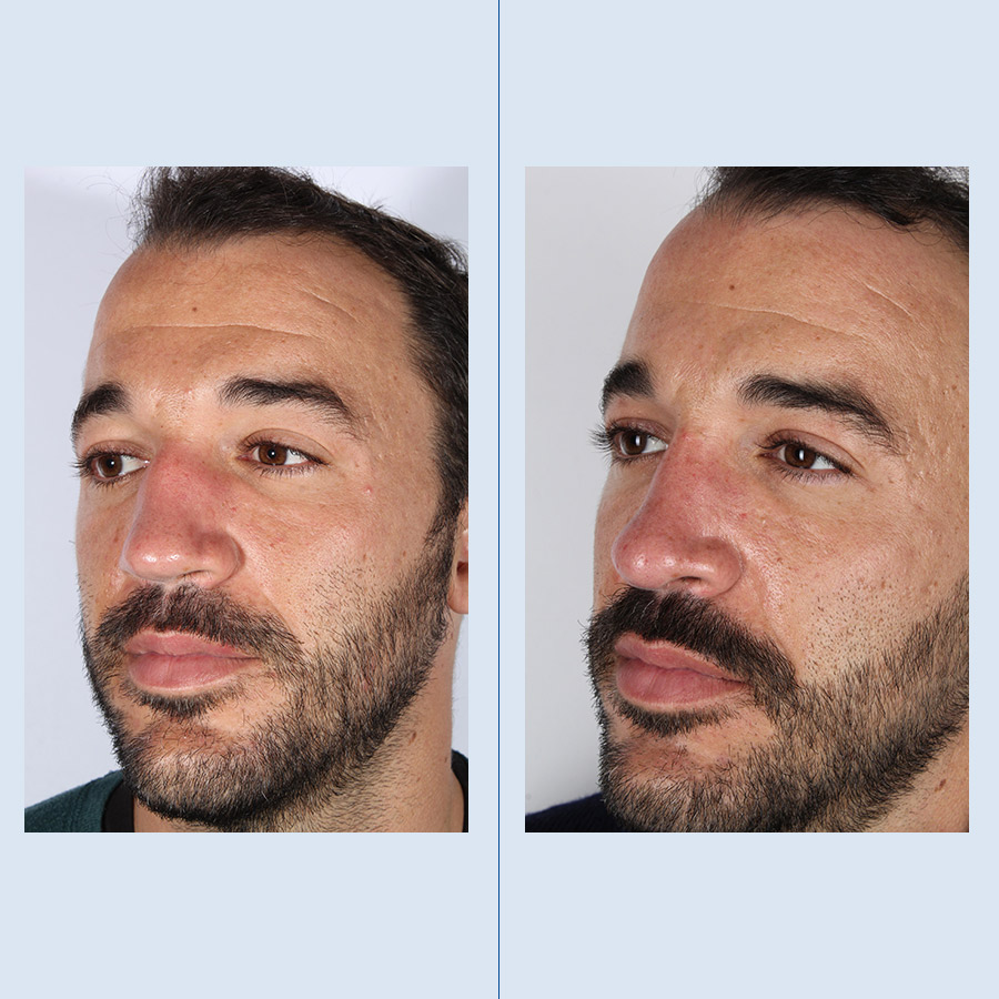 Rinoplastia Ultrasónica