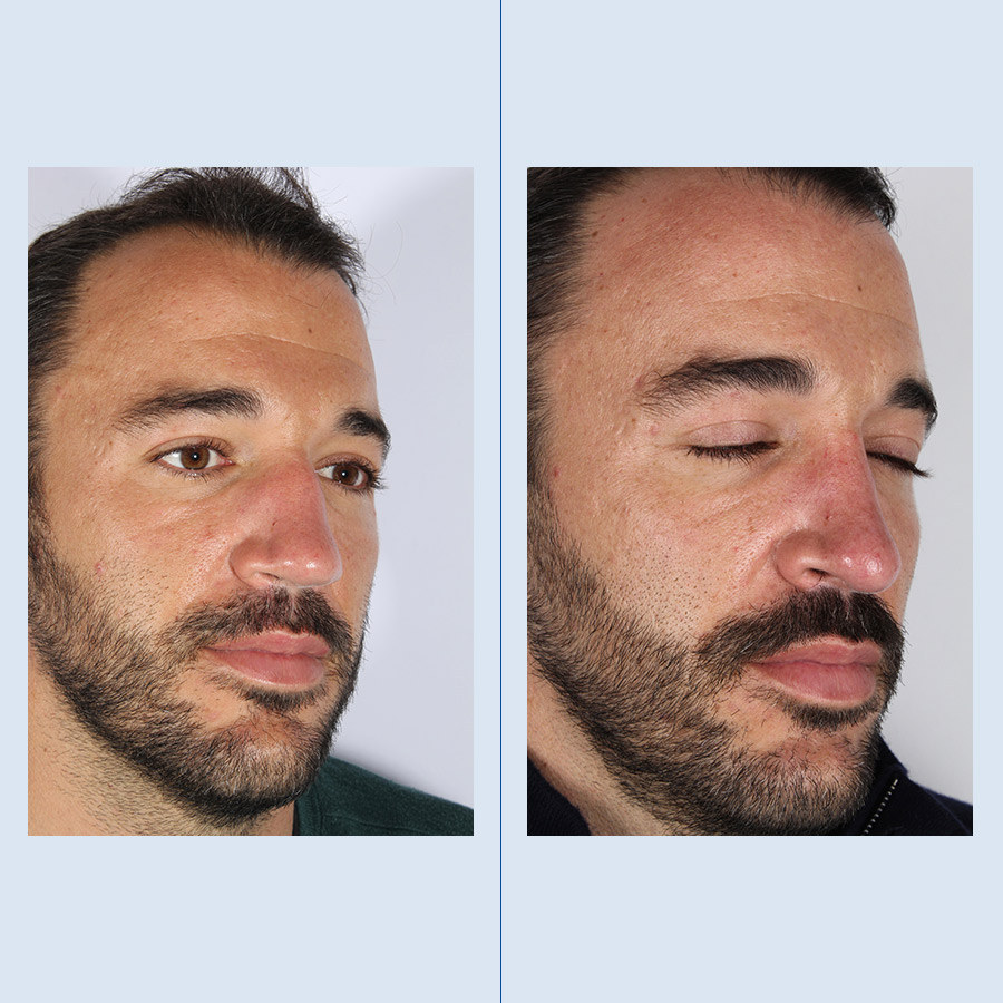 Rinoplastia Ultrasónica