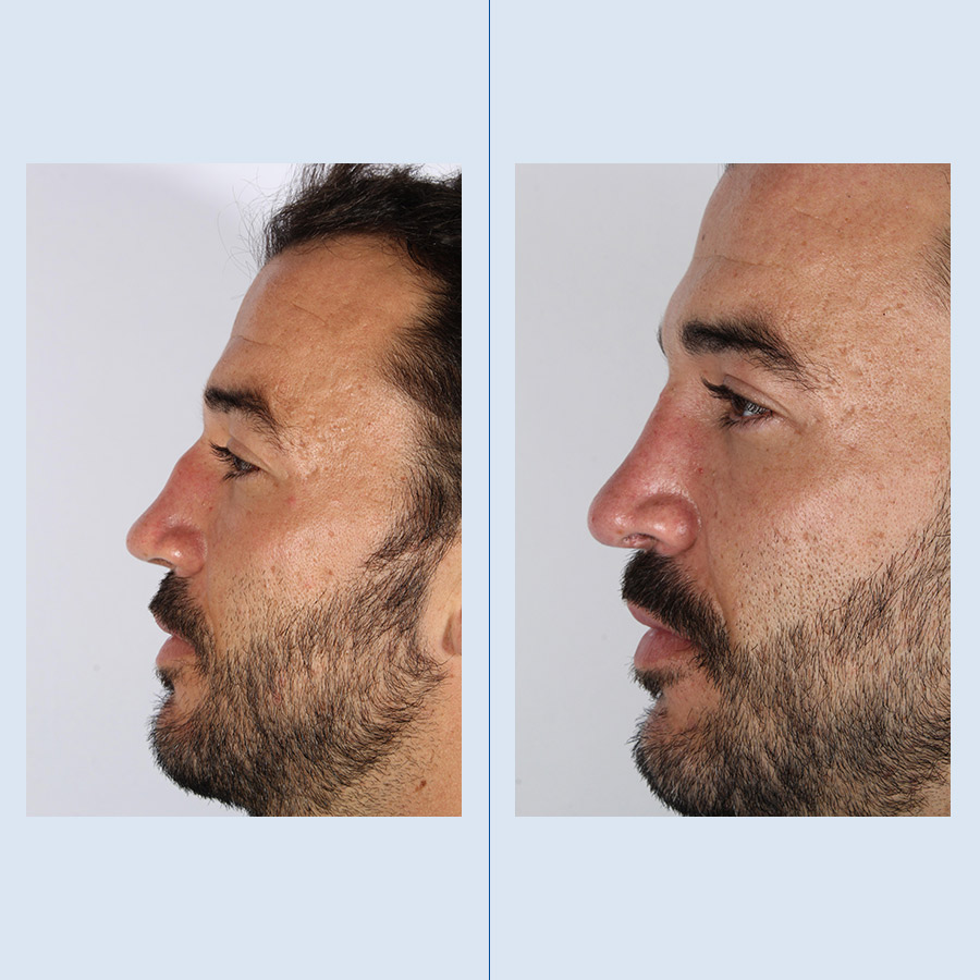 Rinoplastia Ultrasónica