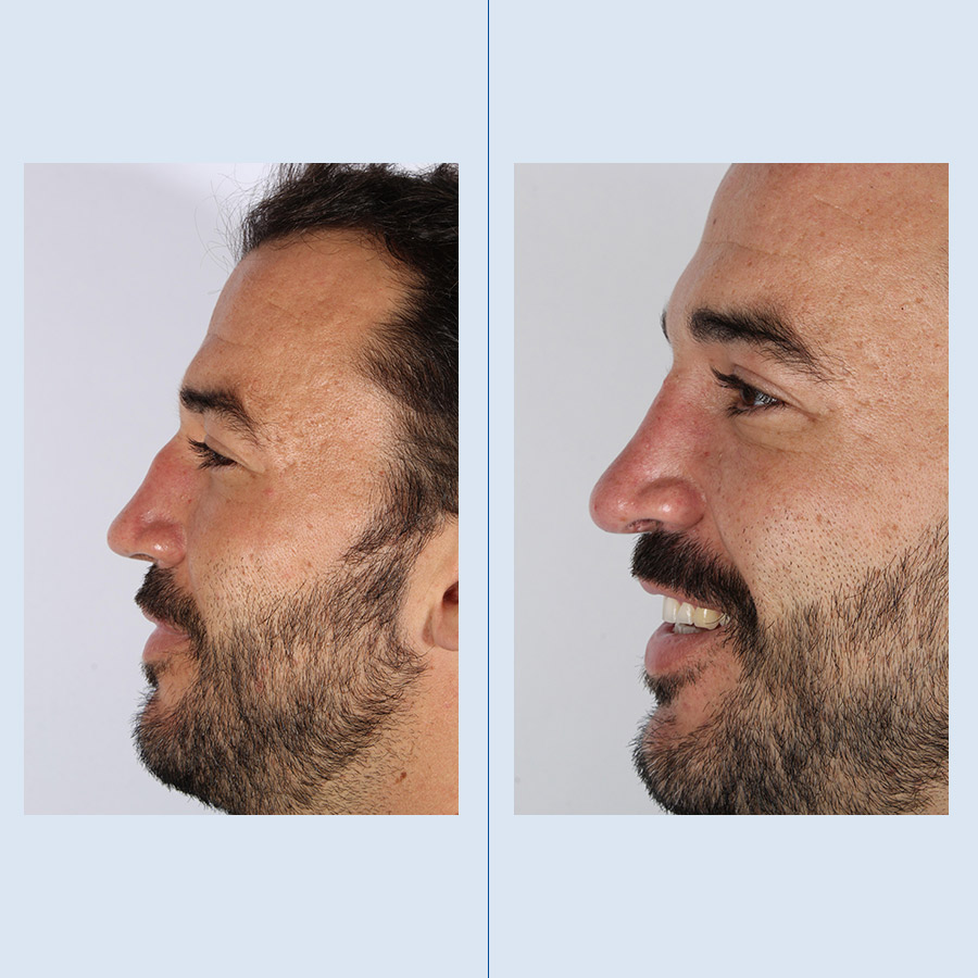 Rinoplastia Ultrasónica