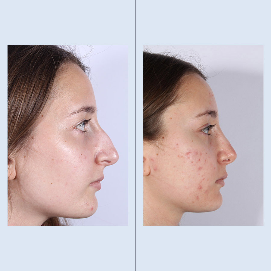 Rinoplastia Ultrasónica