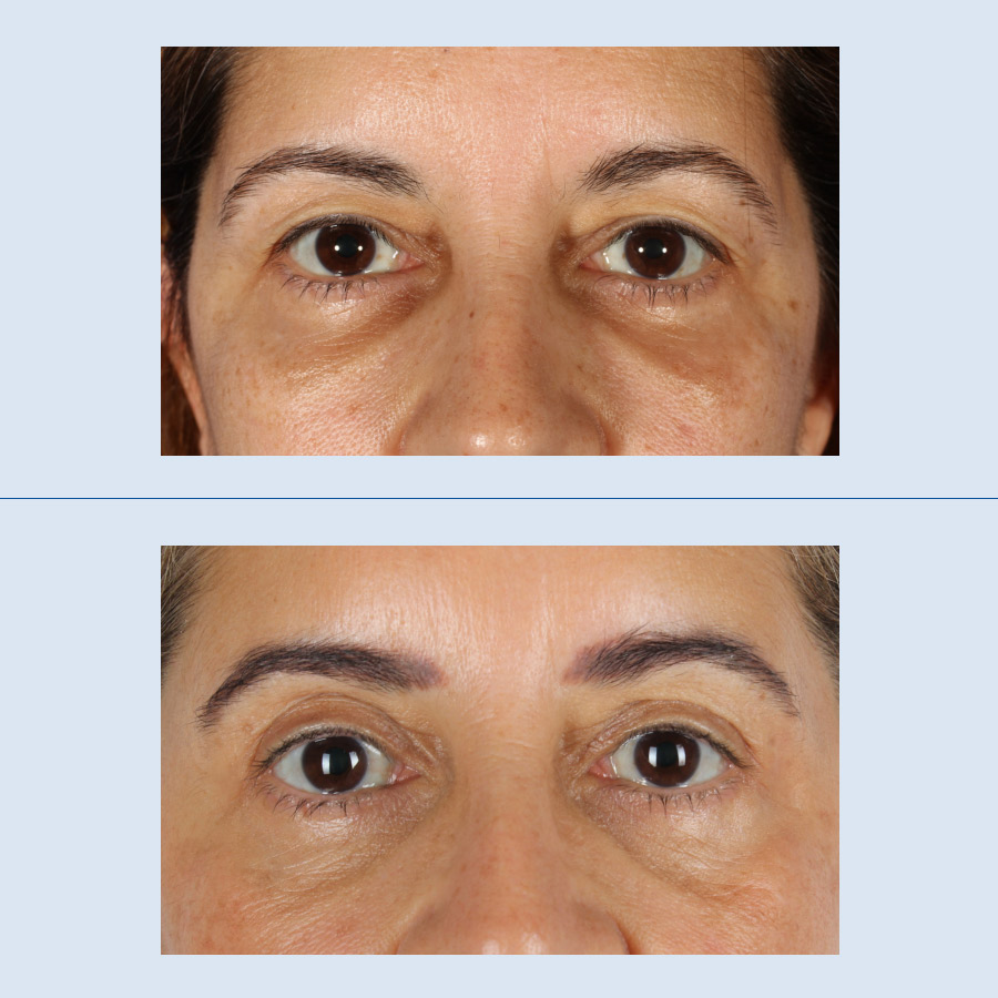 Antes y Después Blepharoplasty