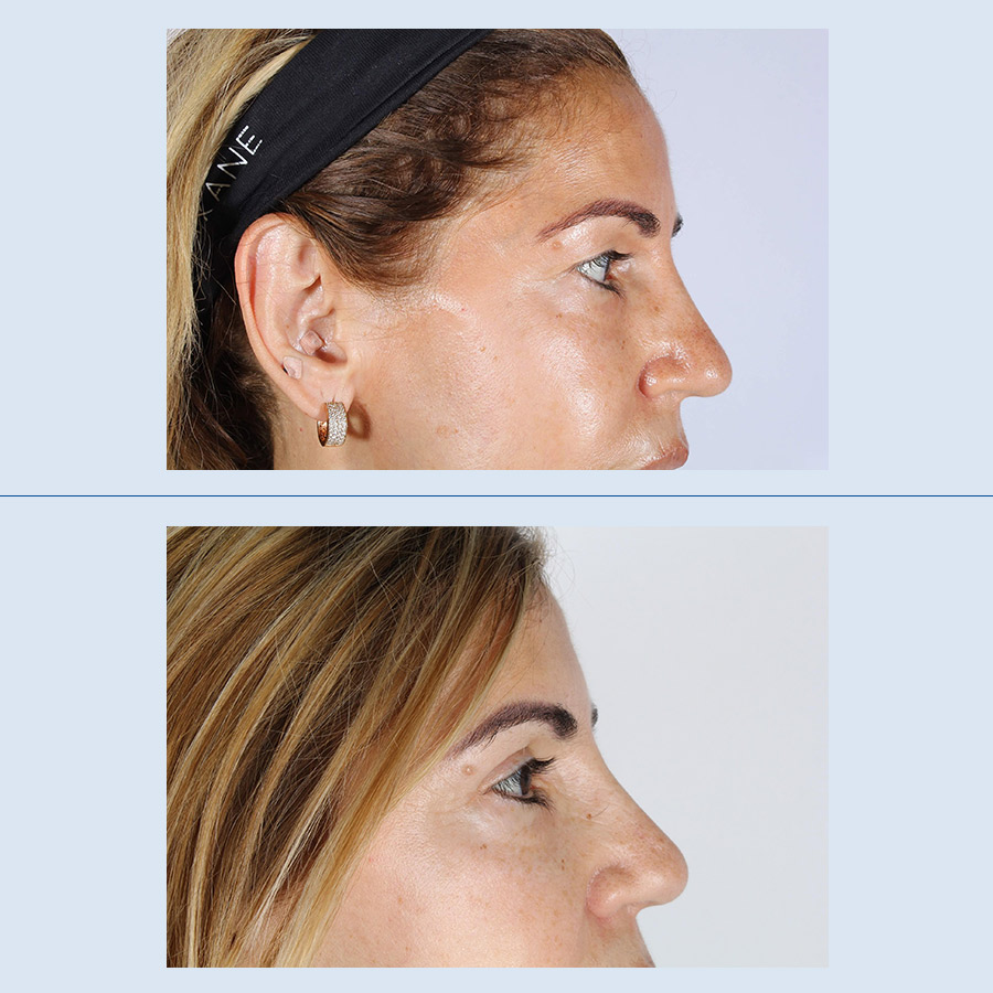 Antes y Después Blefaroplastia