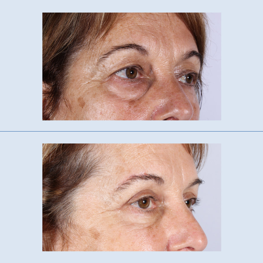 Antes y Después Blepharoplasty