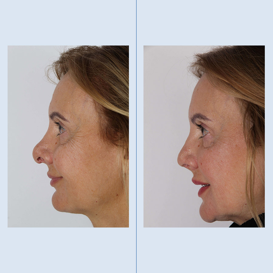 Rinoplastia Ultrasónica