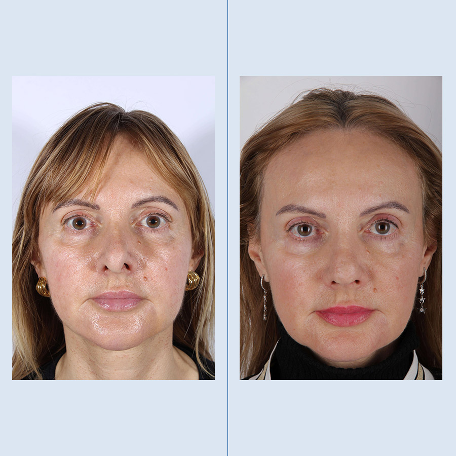 Rinoplastia Ultrasónica