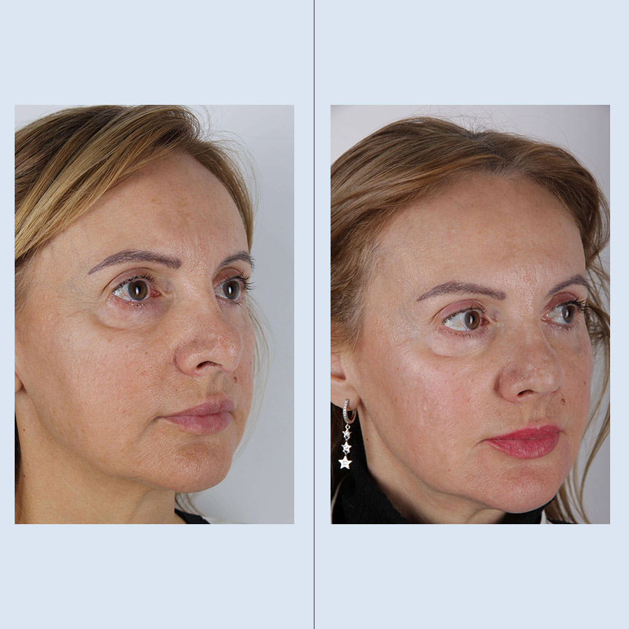 Rinoplastia Ultrasónica