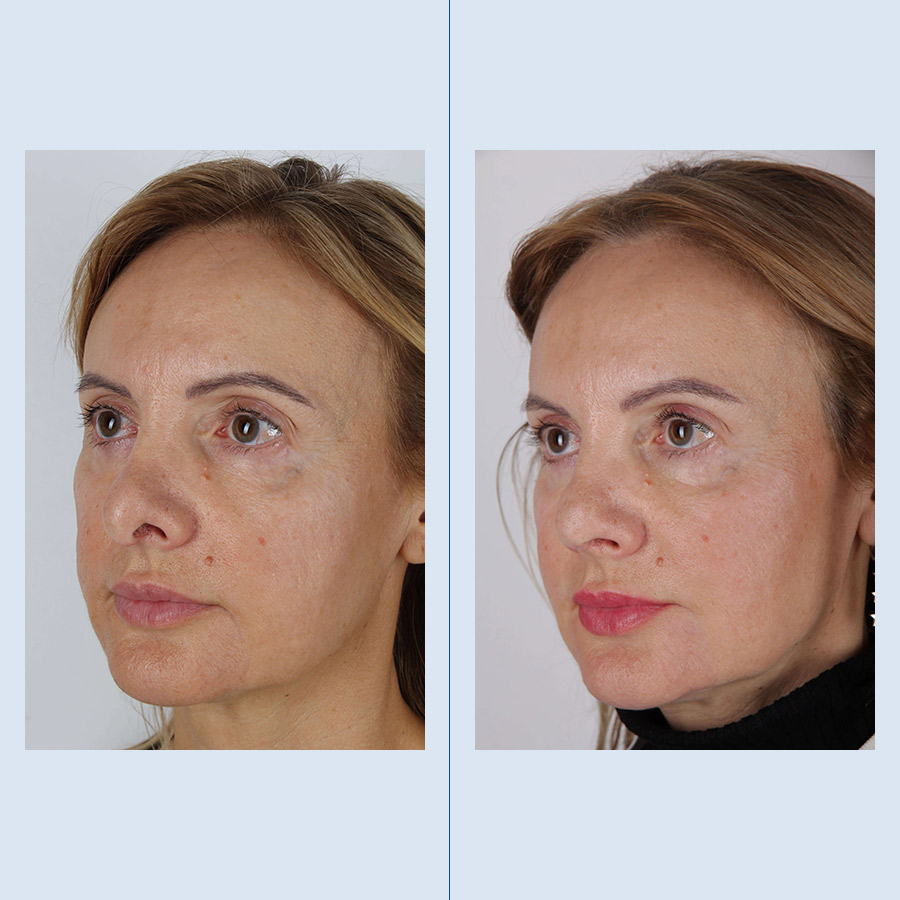 Rinoplastia Ultrasónica